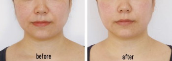 法令線before_after