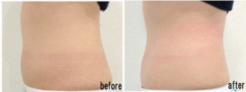 ウエストbefore_after
